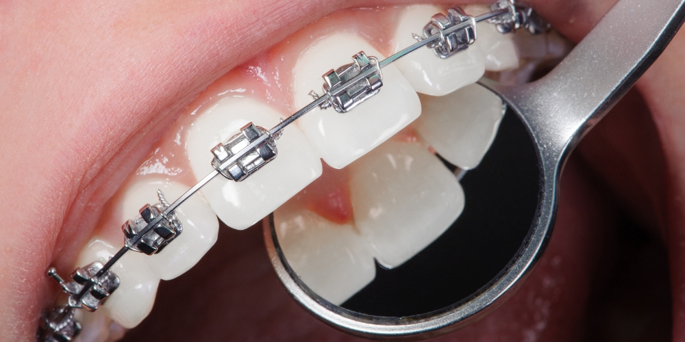 rh-smile-clinic-clinica-de-argoncilhe-16